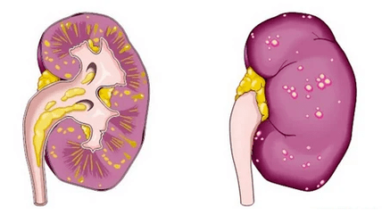 Τι είναι η οξεία προστατίτιδα