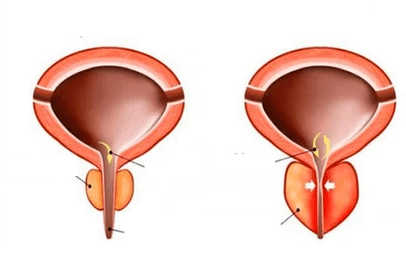 Τι είναι οξεία προστατίτιδα